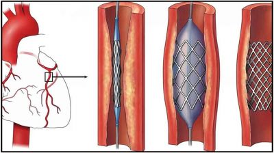 হার্টের রিংয়ের নতুন দাম কার্যকর ১ অক্টোবর থেকে