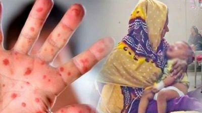 দেশজুড়ে হামে আক্রান্তর সংখ্যা বাড়ছে, ২৪ ঘণ্টায় আরও ১১ জনের মৃত্যু