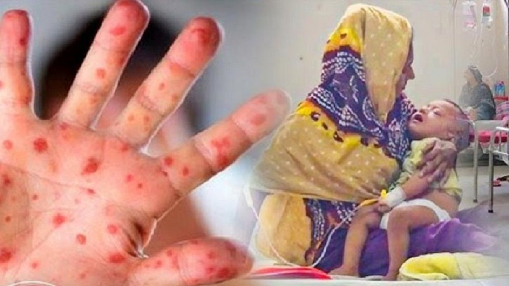 হাম ও হামের উপসর্গে ৫ জনের মৃত্যু