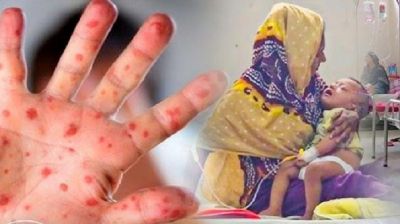 হাম ও হামের উপসর্গে ৫ জনের মৃত্যু