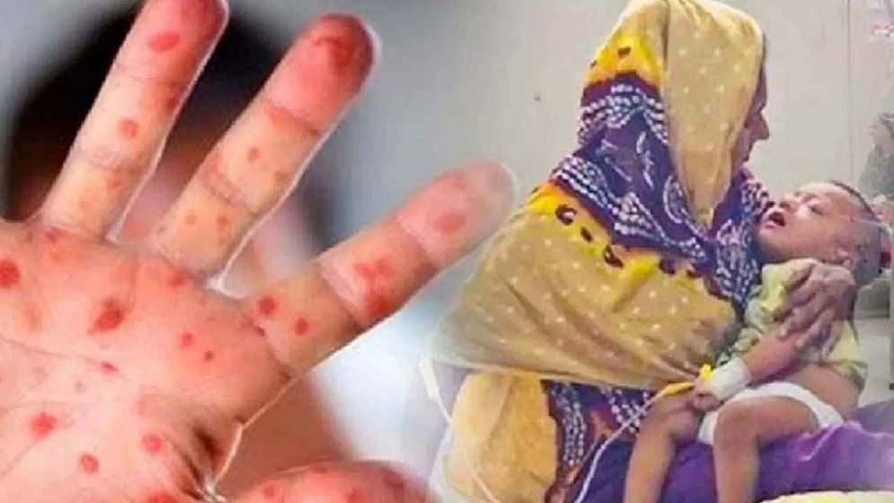 হামের উপসর্গ নিয়ে আরও ৭ শিশুর মৃত্যু