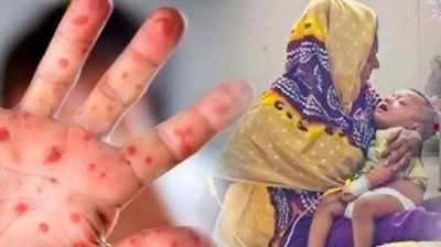 হামের উপসর্গ নিয়ে আরও ৭ শিশুর মৃত্যু