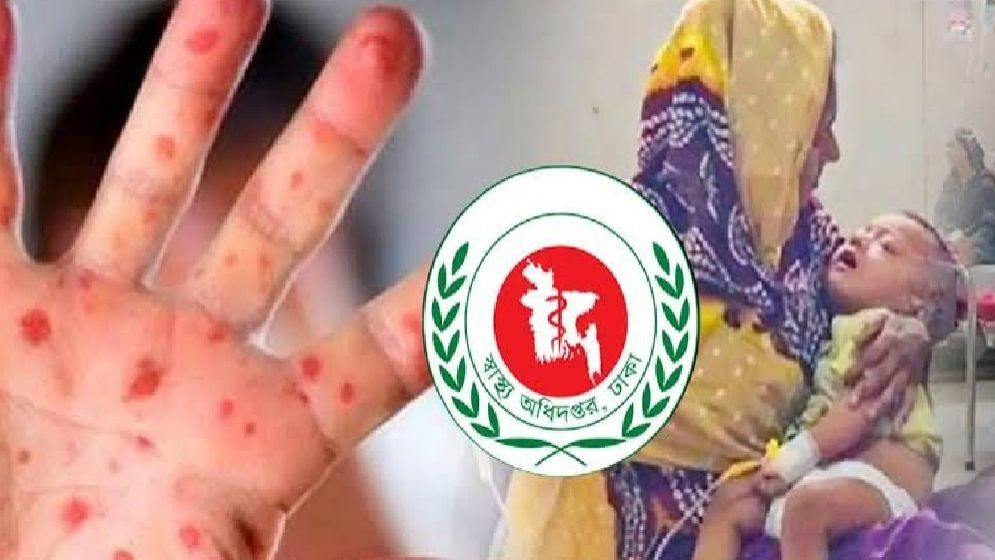 হাম উপসর্গে আরও ৩ জনের মৃত্যু