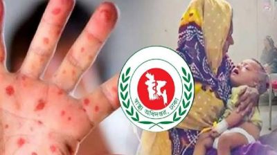 হাম উপসর্গে আরও ৩ জনের মৃত্যু