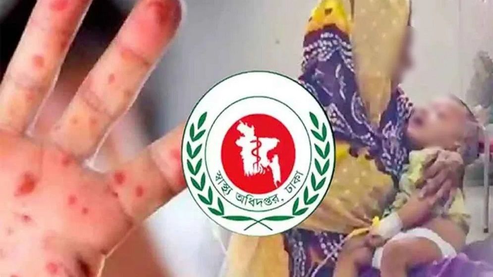 হাম উপসর্গে আরও ৭ শিশুর মৃত্যু