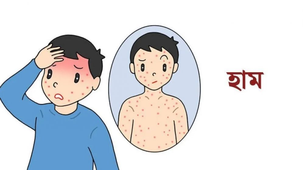 হামের উপসর্গে আরও ৭ জনের মৃত্যু, ২৪ ঘণ্টায় শনাক্ত ১৩১৫