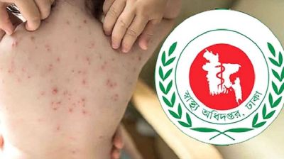 হাম উপসর্গে প্রাণ গেল আরও ৮ জনের